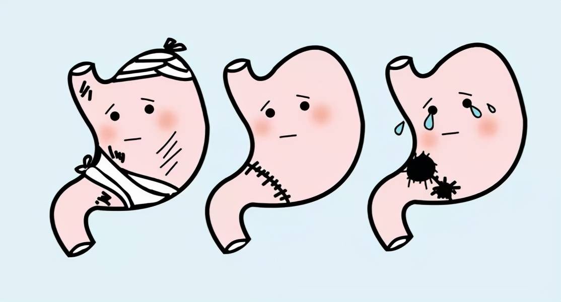 这四种胃病会癌变,你有中招吗?