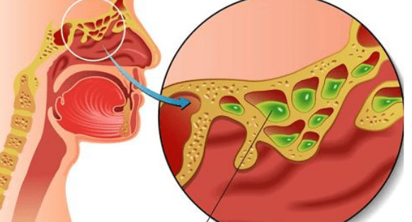 家长|1药网科普：为什么宝宝总是鼻塞？