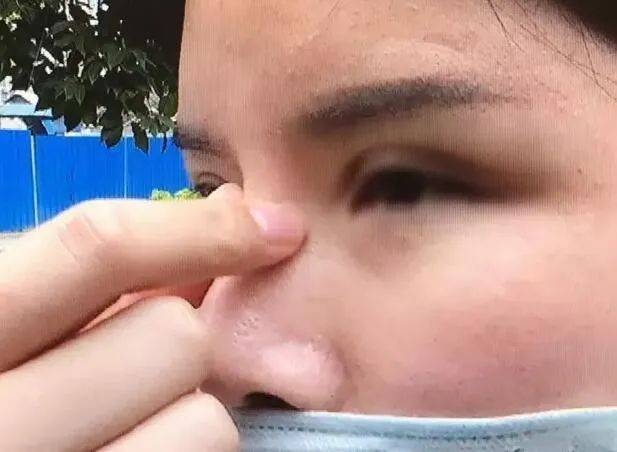 张力|五官C位可不能随便动,鼻综合也不是人人适合!