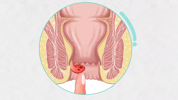 大便痔疮脱出怎么办