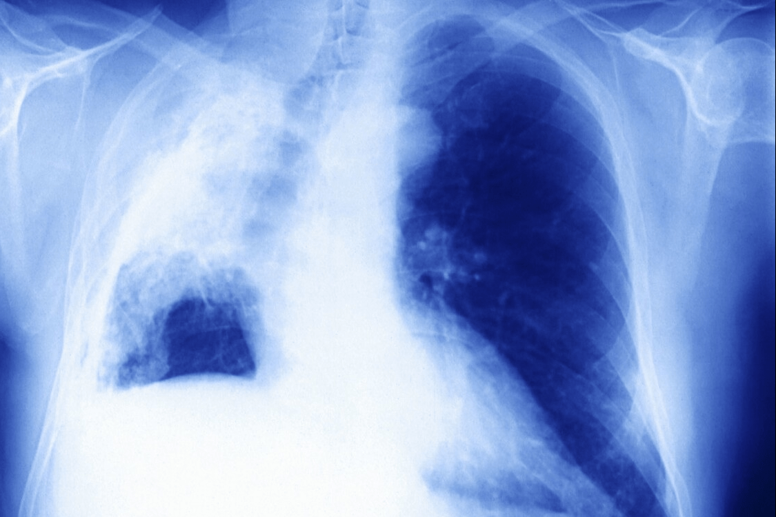 肺癌晚期alk突变 肺腺癌4期alk突变