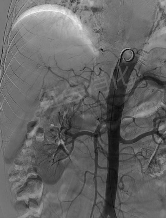 血管|西安市红会医院 让肿瘤“饿”死的TACE术 为两例中晚期肝癌排忧