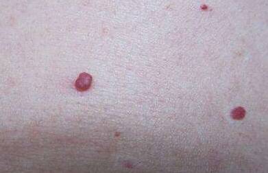 肝脏|身体出现这种“肉痣”，可能是肝脏的“呼救信号”，尽量别忽视