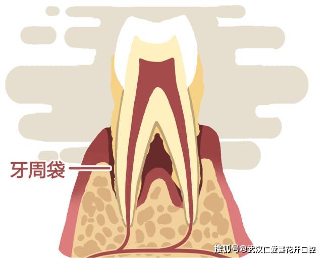 即 牙周袋的形成