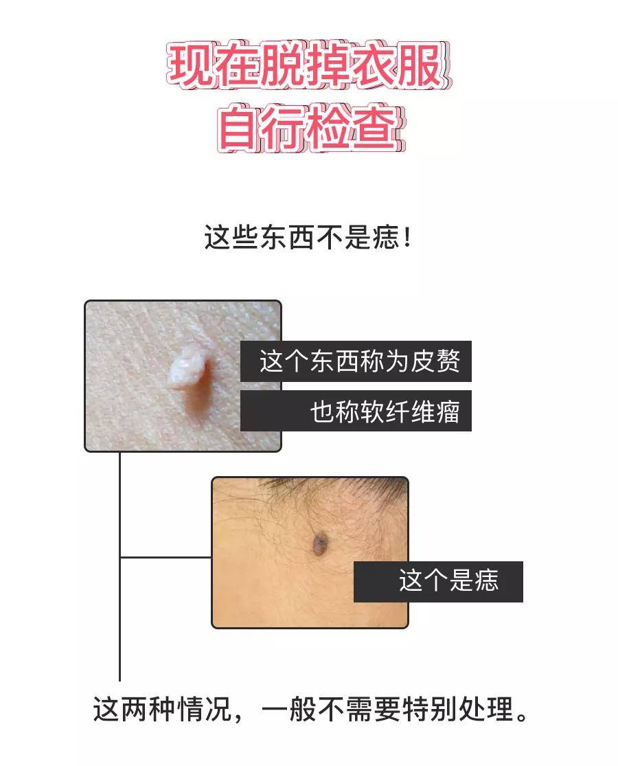 身上长瘊子是感染了HPV病毒!千万别做这件事,会传染给宝宝_疫苗