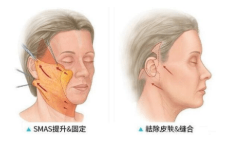 脸部|涨点姿势：脸部做拉皮手术有危险吗？脸部拉皮可以维持多久？