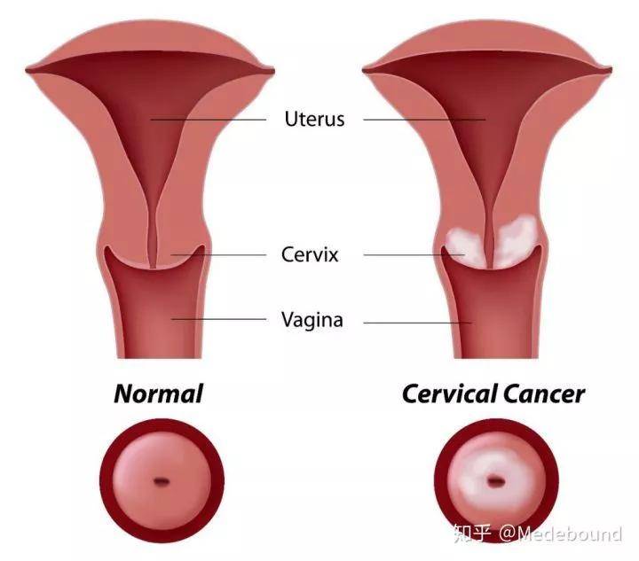 啥是人乳头瘤 53a4ea92418649c7bc6b282838b31d24.jpeg