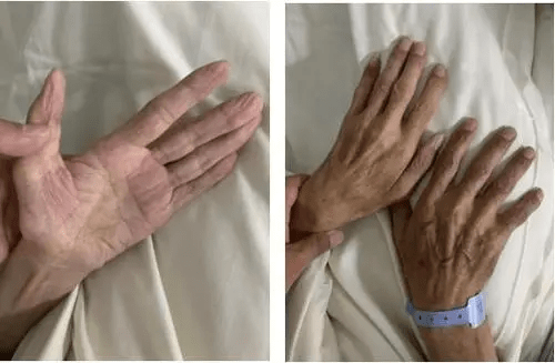 痉挛性|你知道运动神经元分为几种吗？你又是哪一种?