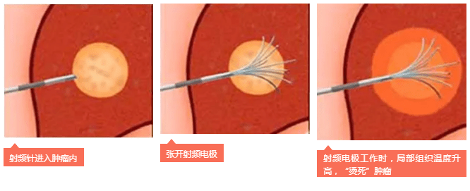 快速消灭肿瘤的射频消融术是什么