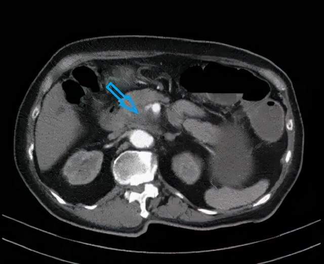 隨後的ct影像顯示病情進展:原發性胰腺腫瘤包住腸繫膜上動脈和靜脈