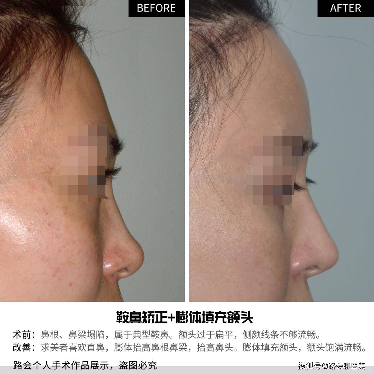面部|为什么说年龄越大，越不建议做脂肪填充？(1) 头条文章