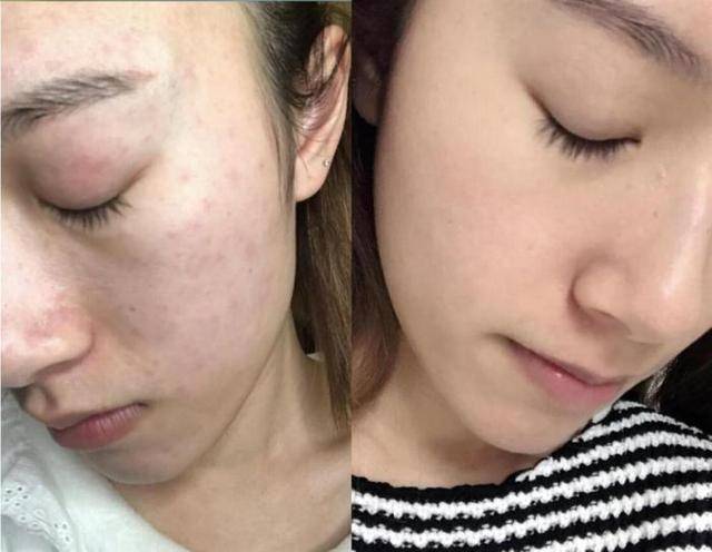 黑头|刚打湿脸就涂洗面奶？难怪出油严重黑头疯长，教你正确洗脸方式！