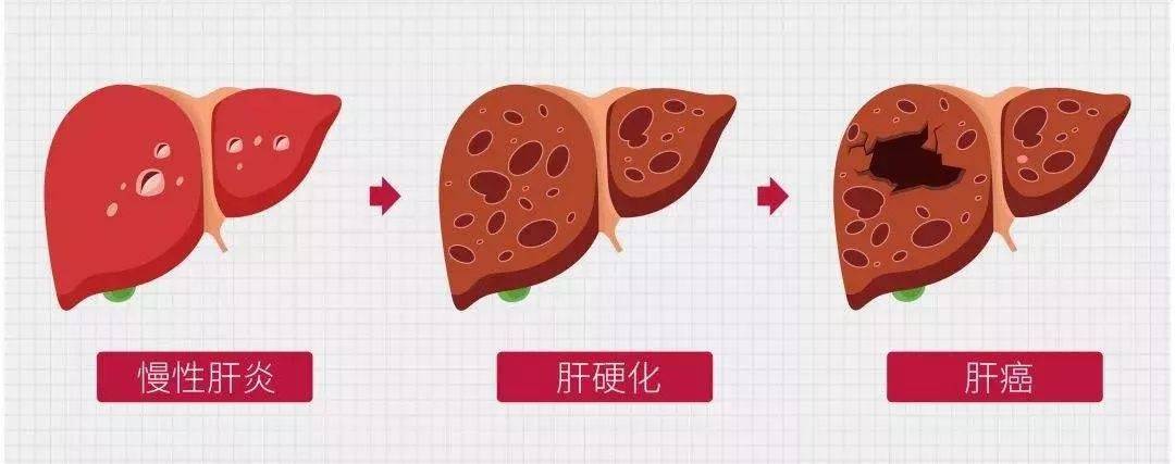 治疗|广州和谐梁萍主任：乙肝治疗过程中的5个核心部分，一个也不能缺乏！