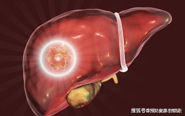 毒素|肝癌发现即晚期?医生提醒:睡觉时出现3“异常”,劝你早查肝CT