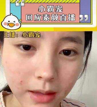 化妆品小霸宠首次透露素颜直播原因，审美跟大家不同，觉得满脸痘很好看