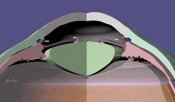 激光|激光周边虹膜切除术