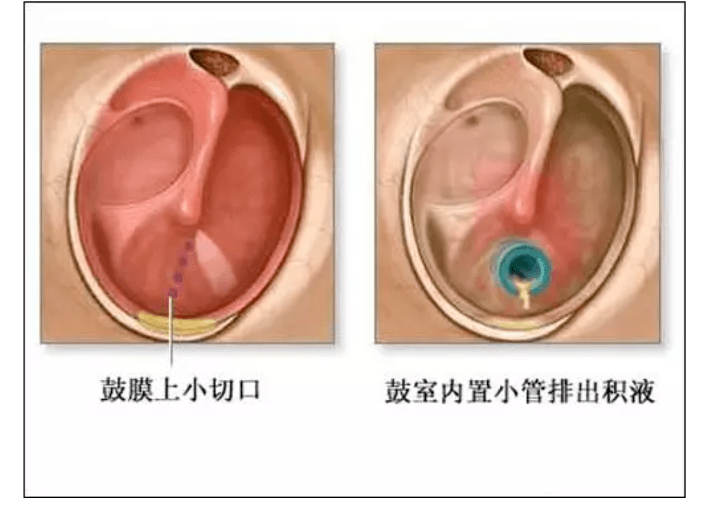 手术|耳闷!说话有回音!应警惕分泌性中耳炎
