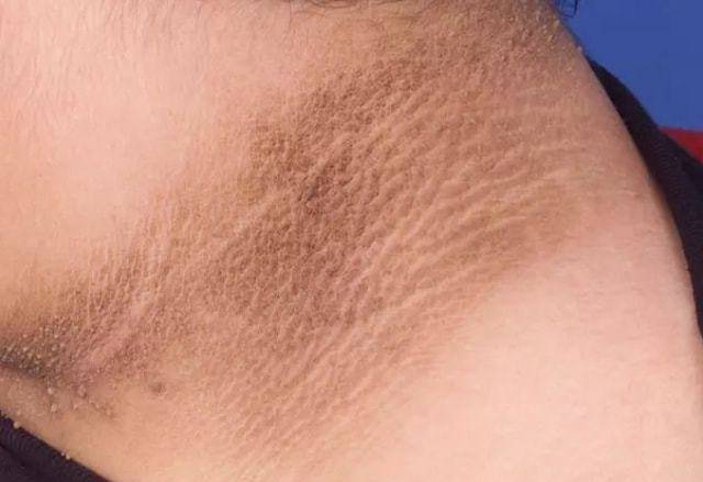 变化|胰岛“保护伞”已找到，不是洋葱，日常紧着吃，血糖或降低