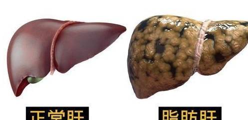 脂肪是怎么消耗排出的 4afe0d7a260d475c847bf959c66a9dcf.jpeg