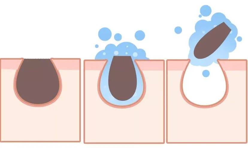 用"魔法"把鼻子变漂亮,教你正确去黑头