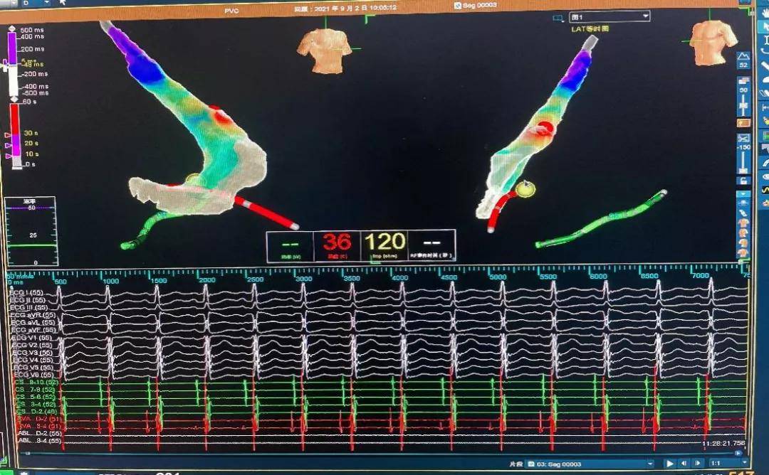 王健|北京老年医院室速射频消融术成功实施