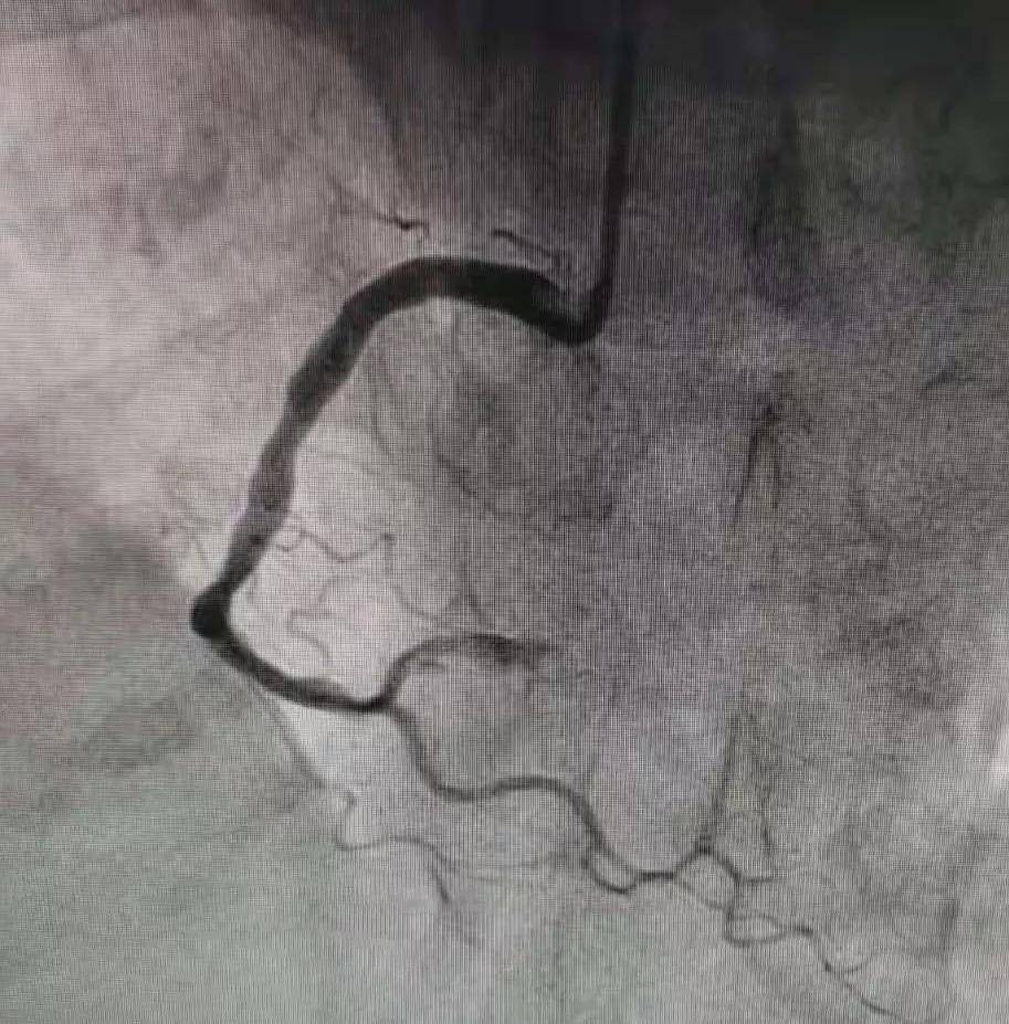 心肌|心梗救治，分秒必争 —— 我院心内科成功救治一位急性心梗患者