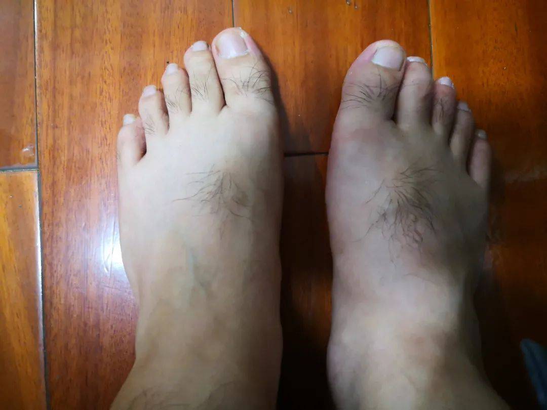 尿酸|参加婚宴后，小伙半夜从梦中痛醒！他的习惯很多人都有