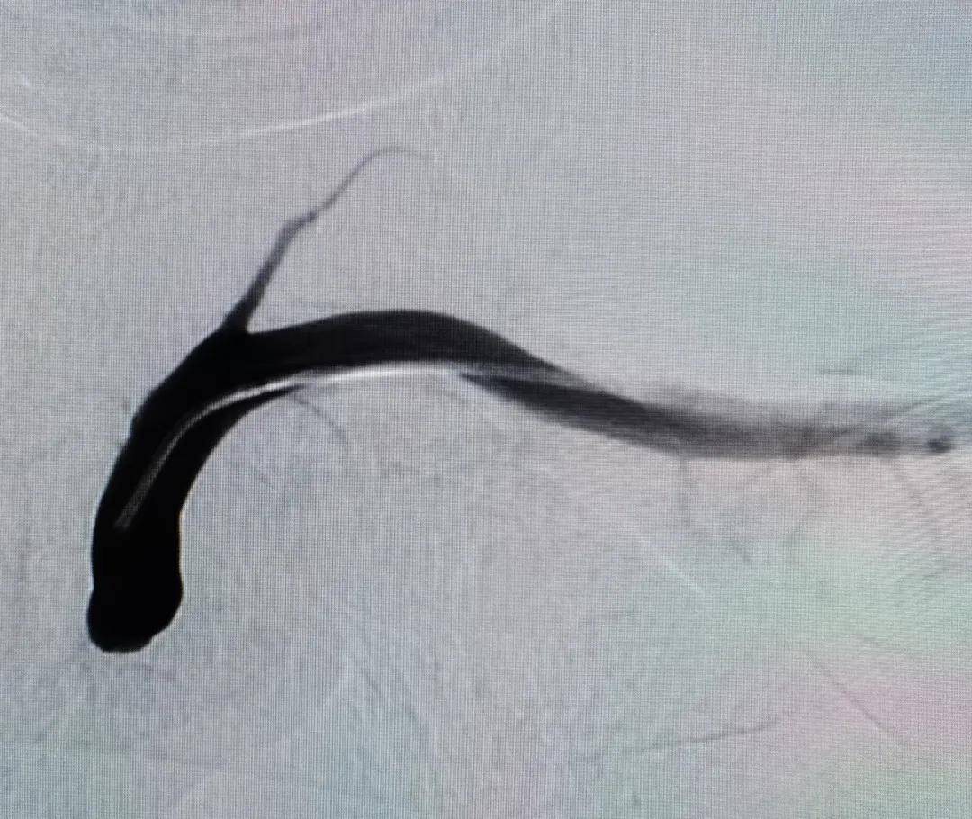 技术|北京老年医院成功完成经桡动脉入路慢性锁骨下动脉闭塞再通术