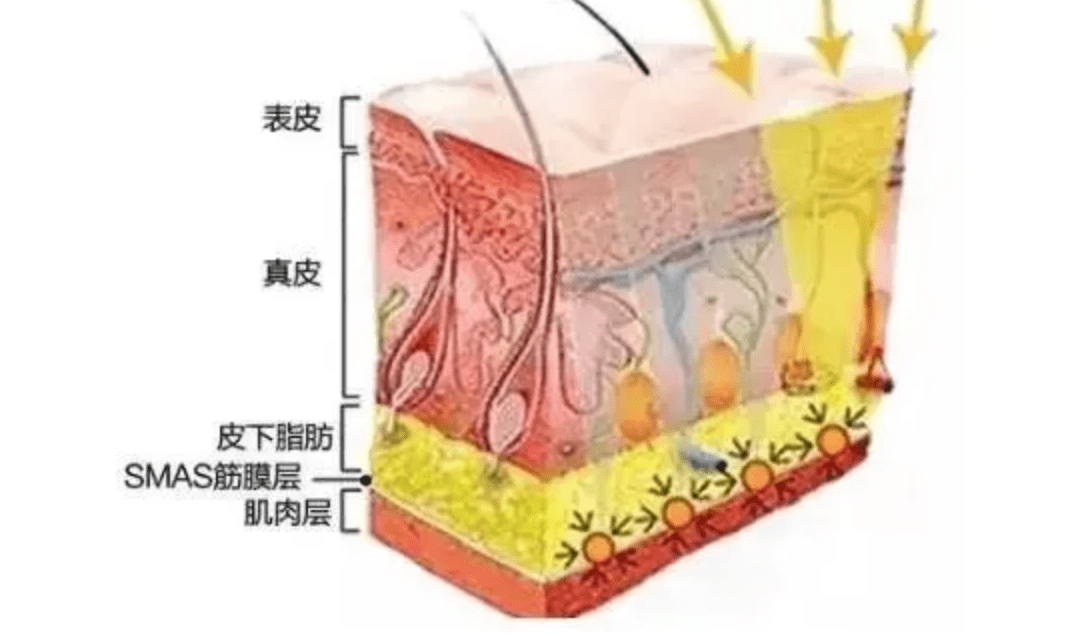 玛吉fotona4d和热玛吉哪个好，fotona和热玛吉的区别，你可以这样去选择