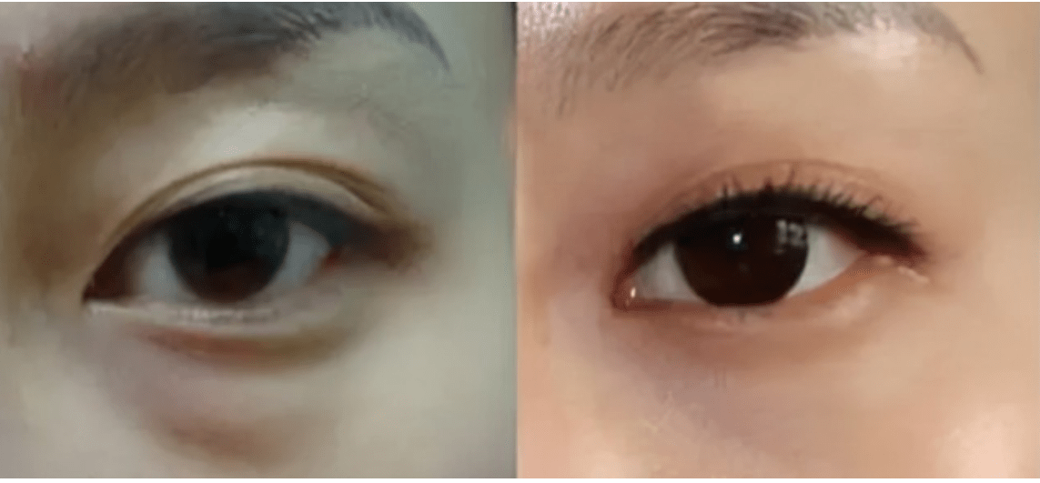 眼袋蛋白线埋线去眼袋好吗 如何去眼袋最好呢？