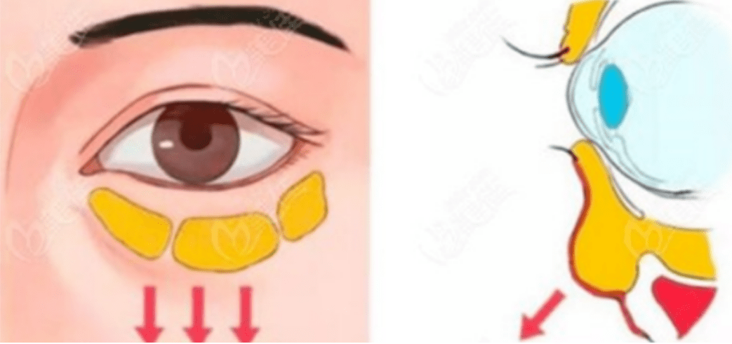 眼袋蛋白线埋线去眼袋好吗 如何去眼袋最好呢？