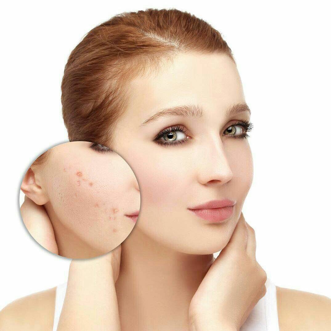 zsks小欣老师祛痘是真的吗痘痘误区