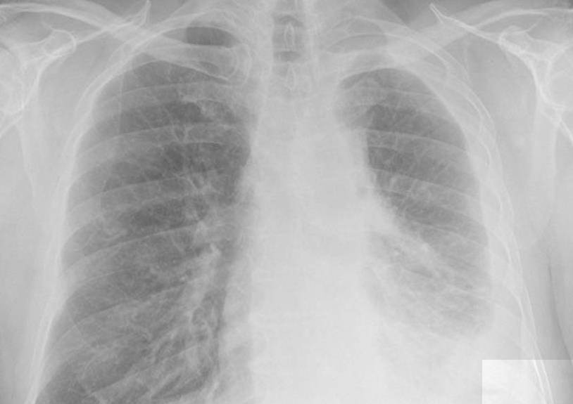 支气管|肺炎不治疗没关系？可能会导致肺脓肿，导致肺部不可逆转损伤