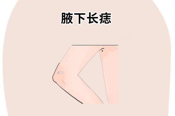 腋下长痣