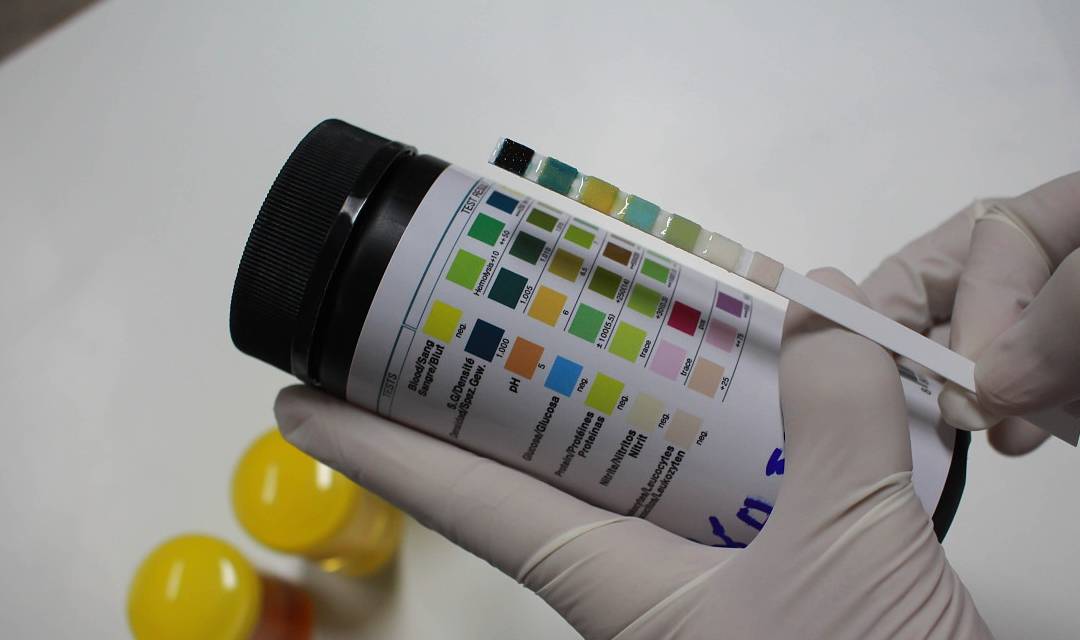 相关|尿检查出潜血而且有3个加号,是什么原因?今天,来告诉各位答案