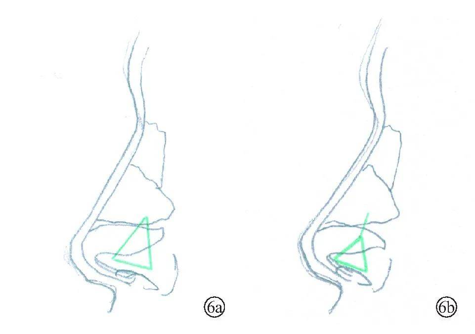 手术|如何do鼻子才能有好的效果？