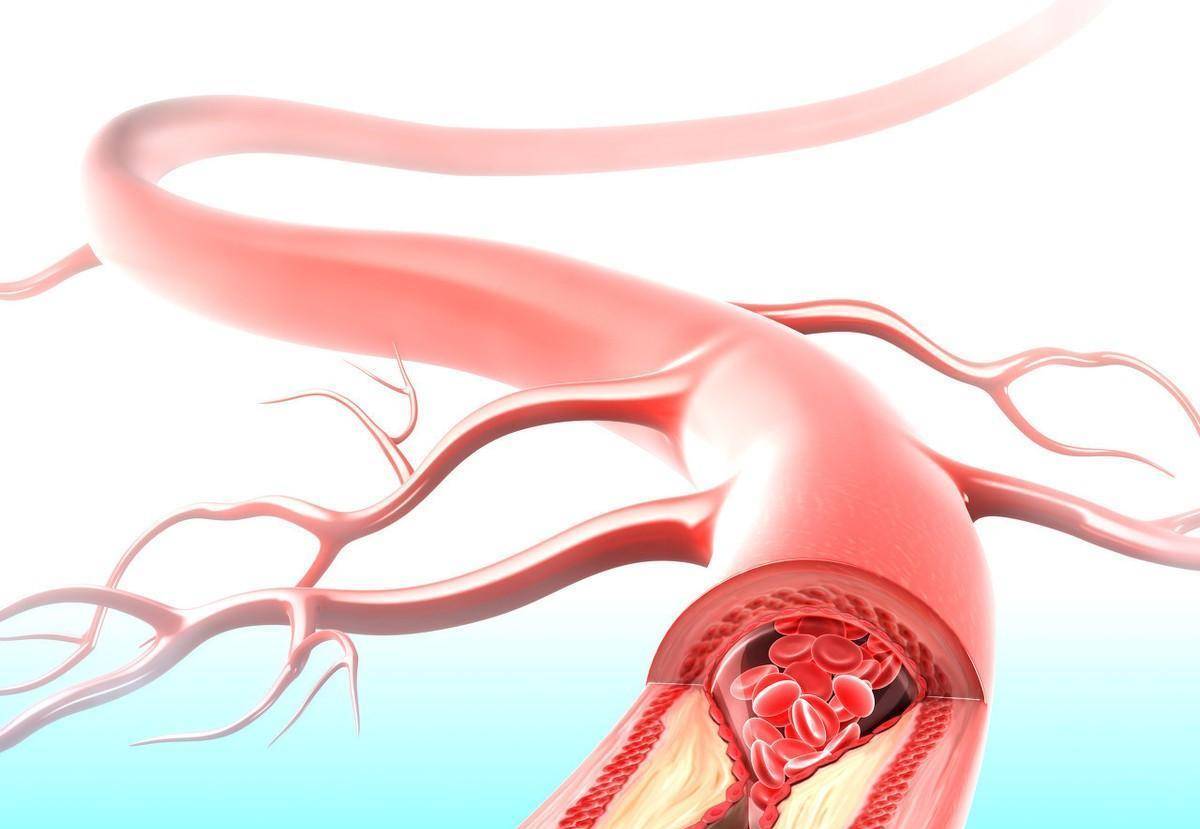 进行|腔隙性脑梗死也是脑梗死么?它们之间有什么区别,机理一样么