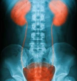 方法|肾积水应如何治疗,要分清楚这些才能有效治疗