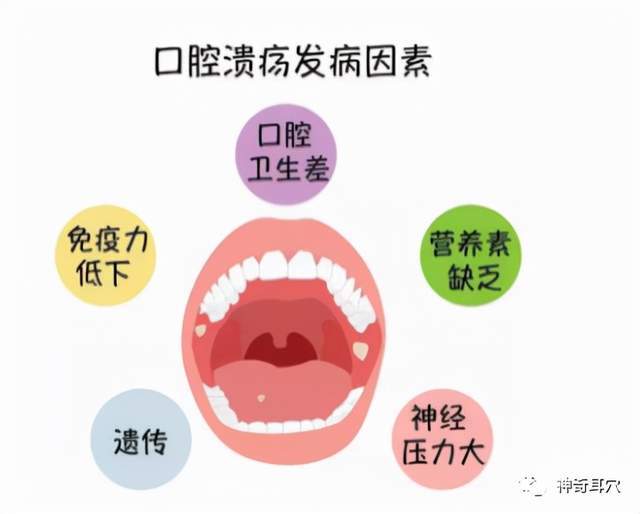 益康耳穴:被口腔潰瘍困擾的你,還不知道這個妙招嗎?