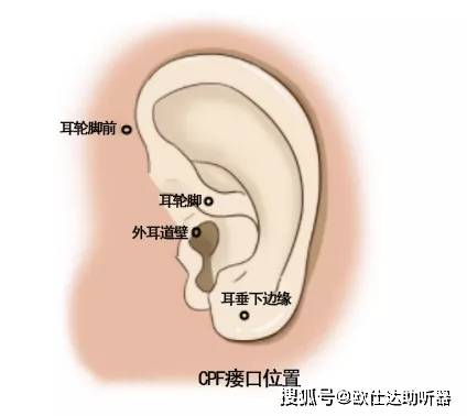 瘻管開口多位於耳輪腳前,少數可在耳廓的三角窩或耳甲腔部.