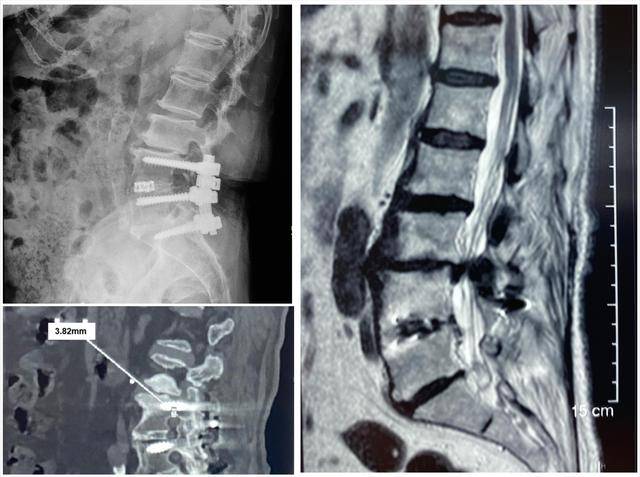 首例|西北首例！O臂结合“天玑”机器人CBT置钉为高龄患者实施腰椎翻修
