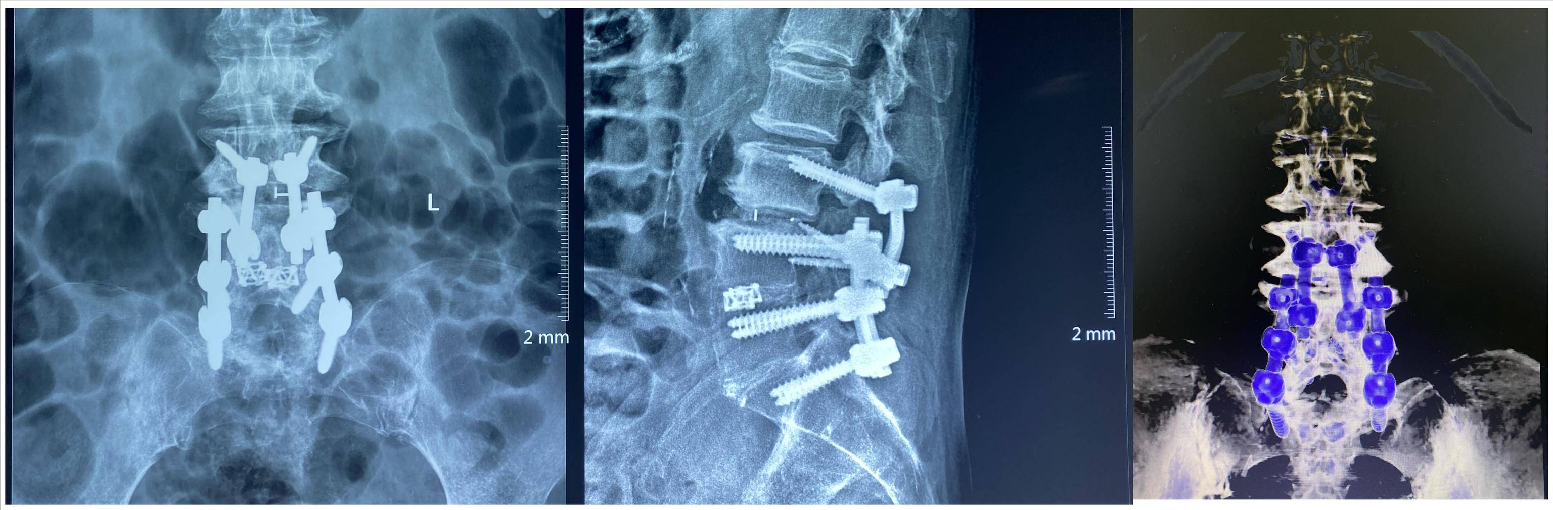 首例|西北首例！O臂结合“天玑”机器人CBT置钉为高龄患者实施腰椎翻修