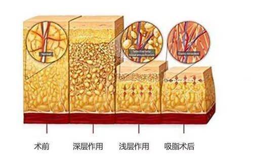 审美脂肪修复任学会：如何避免自体脂肪丰臀术后修复