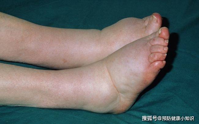 功能|肝不好，脚先知，医生提醒：双脚有3个异常，多半是肝在“呼救”