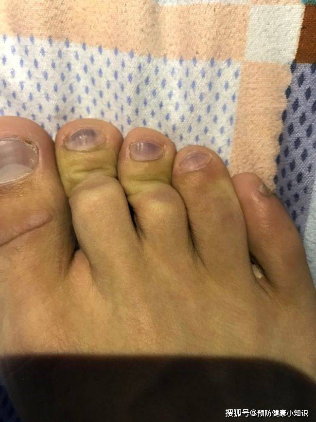 功能|肝不好，脚先知，医生提醒：双脚有3个异常，多半是肝在“呼救”