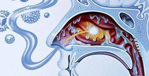 损伤|成都民生耳鼻喉医院提示：别把「涕中带血」不当回事