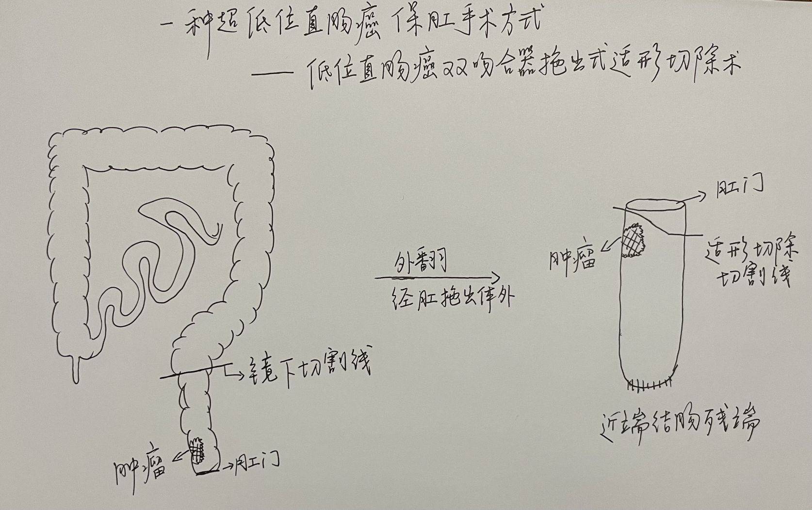 今天我们介绍另外一种超低位直肠癌保肛手术的方法:低位直肠癌双吻合