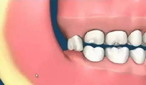 妙手|智齿牙根弯曲紧贴神经管，医生妙手微创拔除