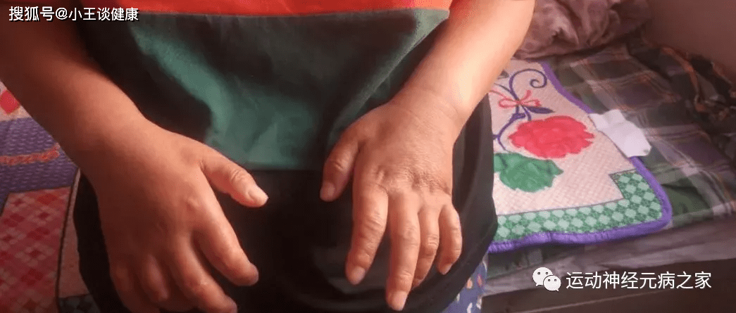 严重|运动神经元病治疗70