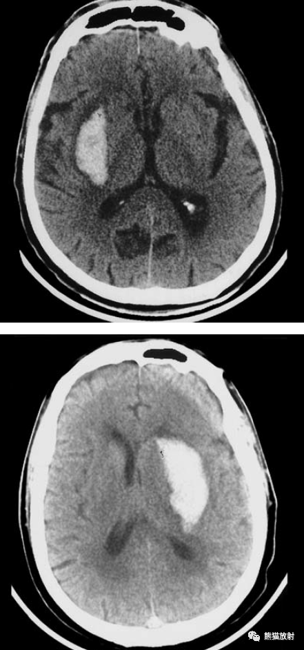 脑实质内出血丨演变分布ct表现